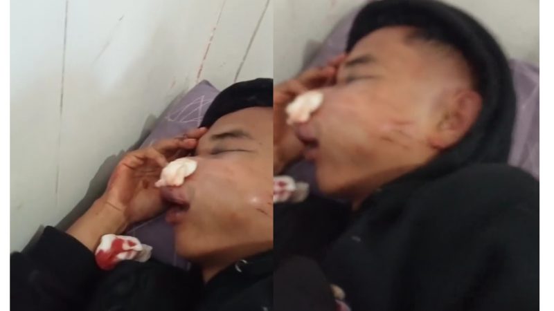 Warga Kota Ruteng Diduga Dianiaya Oknum Polisi, Keluarga Lapor ke Polres Manggarai