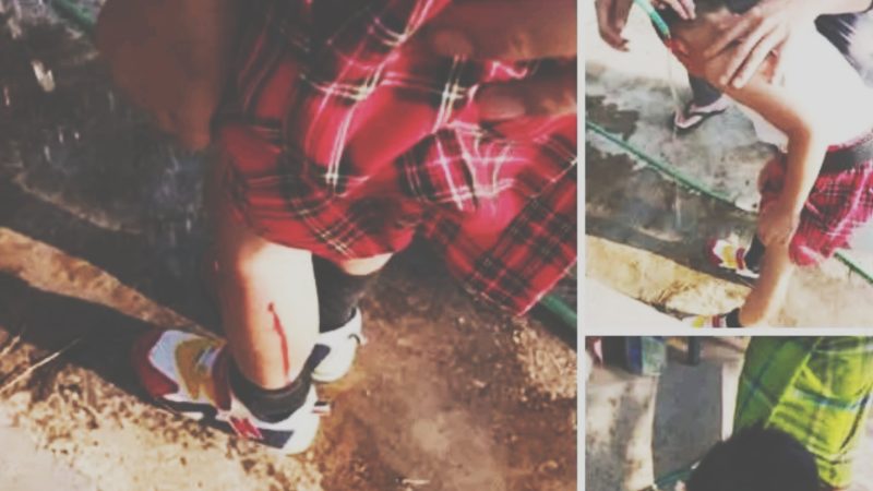 Seorang Siswa di Ruteng Digigit Anjing Diduga Rabies, Begini Kronologinya