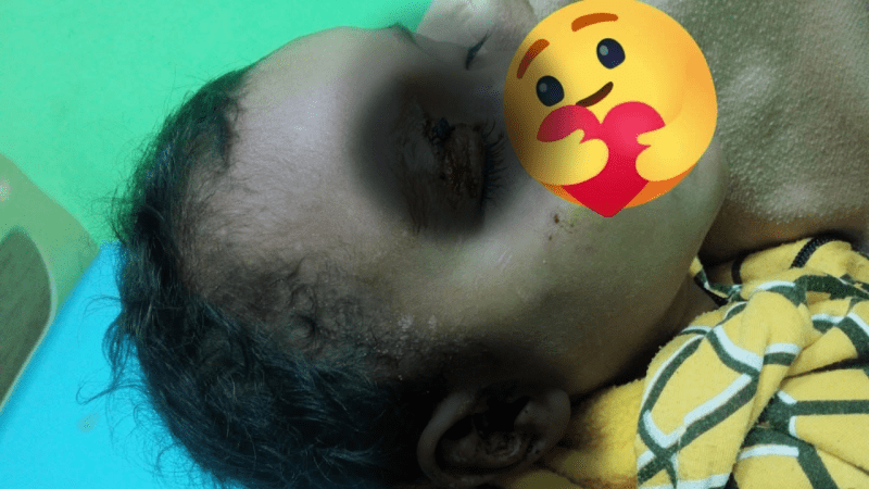 Luka di Wajah Bocah Akibat Gigitan Anjing, Ancaman Rabies Masih Mengintai di Manggarai Timur